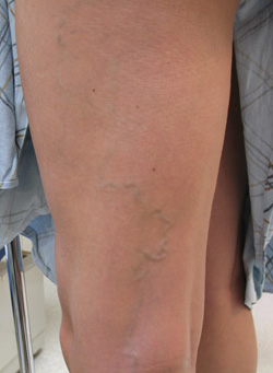 Before Sclerotherapy Treatment