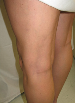 After Sclerotherapy Treatment